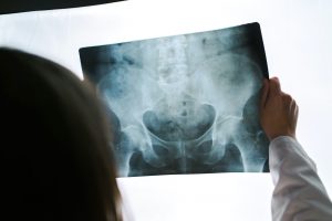 doctor holding a x-ray image of a patients hip
