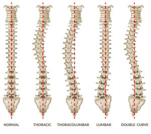 types of scoliosis